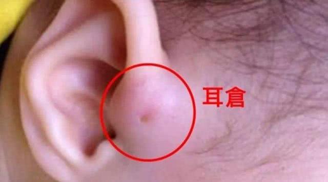 耳朵上的这个小洞千万别挤