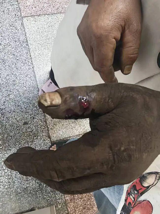 生死边缘的呼唤，一位村民的眼镜蛇咬伤经历与用嘴吸血水的争议